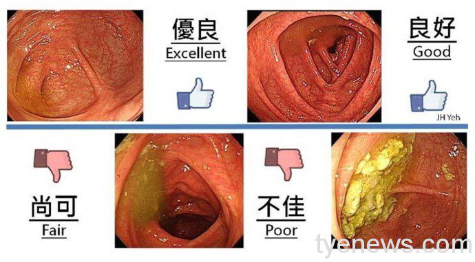 大腸癌治癒率達90%!樂生療養院醫師趙珂漢:早發現早治療 0113 1