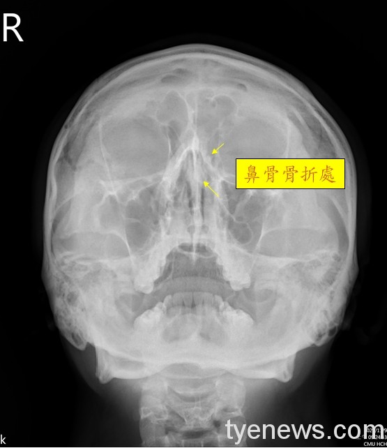 型男運動員撞歪鼻子中醫大新竹附醫微創閉合復位重建正鼻 桃園電子報