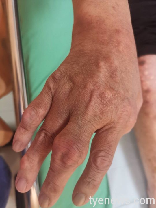 體重破百男大啖海鮮配啤酒引痛風 聯新國際:長期高尿酸是主因 239771 通稿 尿酸鹽結晶沉積在手指關節引發痛風 出現紅腫抽熱痛的症狀 scaled 1