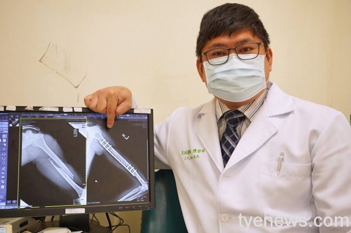 健身男舉重過頭扭斷手臂 聯新國際微創手術助接回 DSC04712 通稿 聯新國際醫院骨科醫師陳哲裕