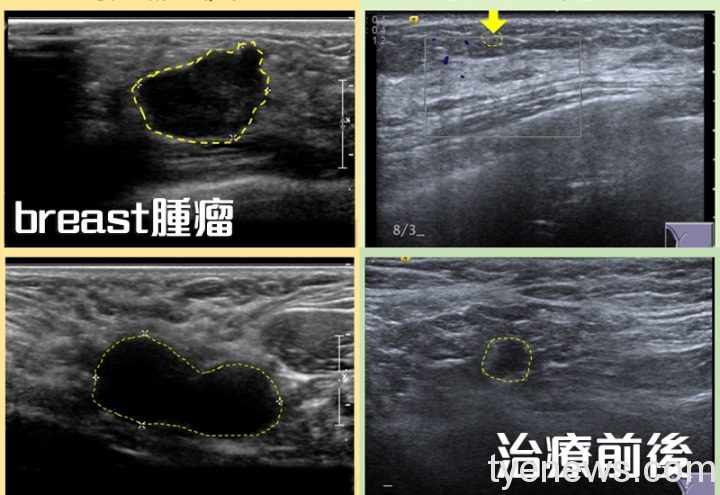 32歲乳癌患者化療及雙標靶 四個月癌細胞掰掰 page 10 1