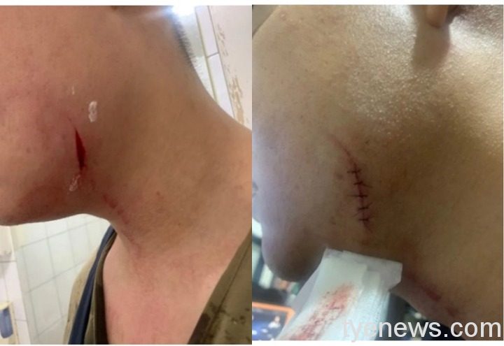男友遭表妹爆打流血縫5針 母顧慮親戚要求息事寧人 page 9 1