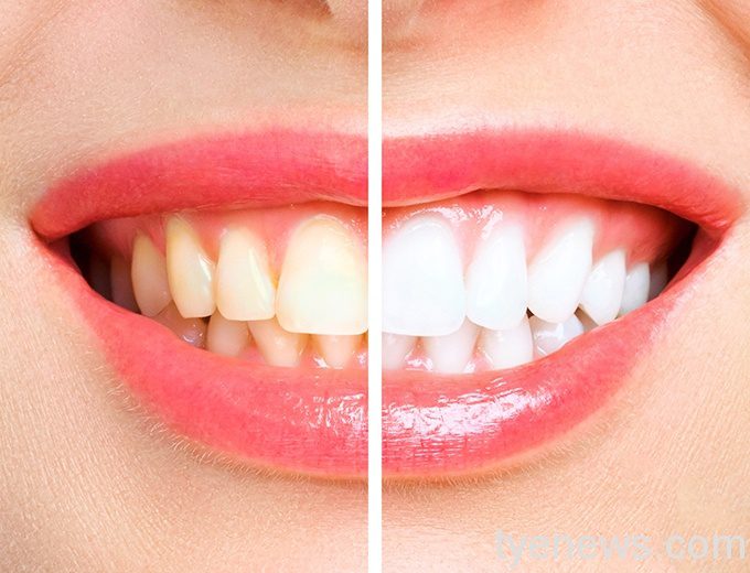 woman teeth before after whitening image symbolizes stomatology