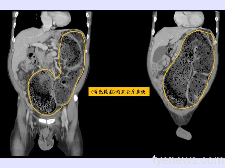 患者腹脹積5公斤宿便 醫師徒手挖出解救 便便