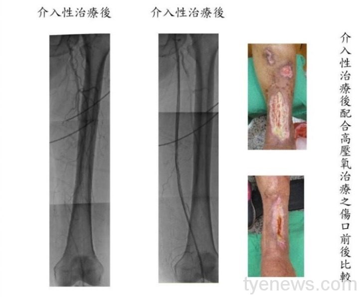 嚴重周邊動脈阻塞性疾病 控制阻塞危險因子避免截肢 傷口前後比較2