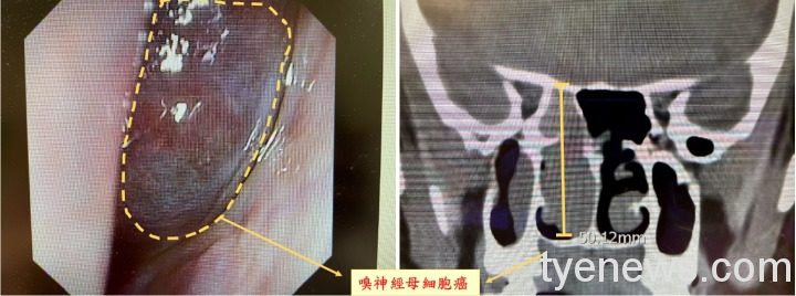 男子長期受鼻塞、鼻涕倒流所苦 求醫揪出惡性腫瘤 嗅神經母細胞癌