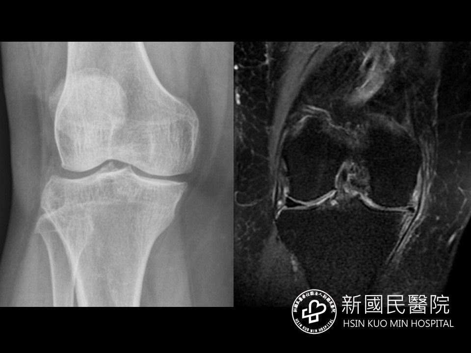 只剩人工膝一條路?北醫新國民醫:這招也能治膝關節退化 圖三 1 2