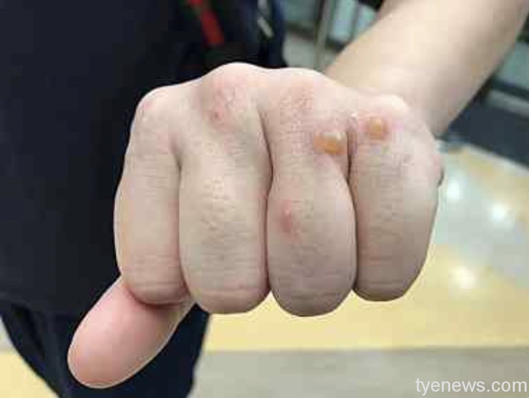 忍手傷苦撐!北醫新國民醫院「疫」起守護社區健康