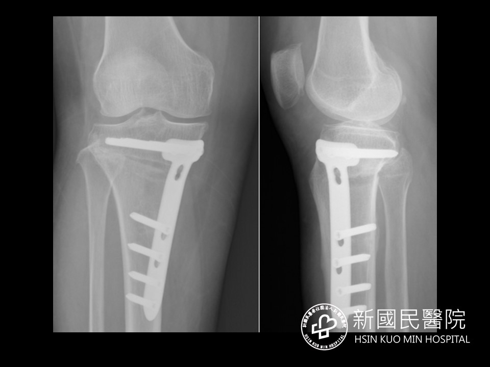 只剩人工膝一條路?北醫新國民醫:這招也能治膝關節退化 圖四 1 2
