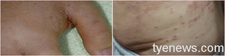 北榮桃分院:冬天皮膚乾燥發癢起疹子 小心疥蟲來寄生 感染疥瘡皮膚外觀。