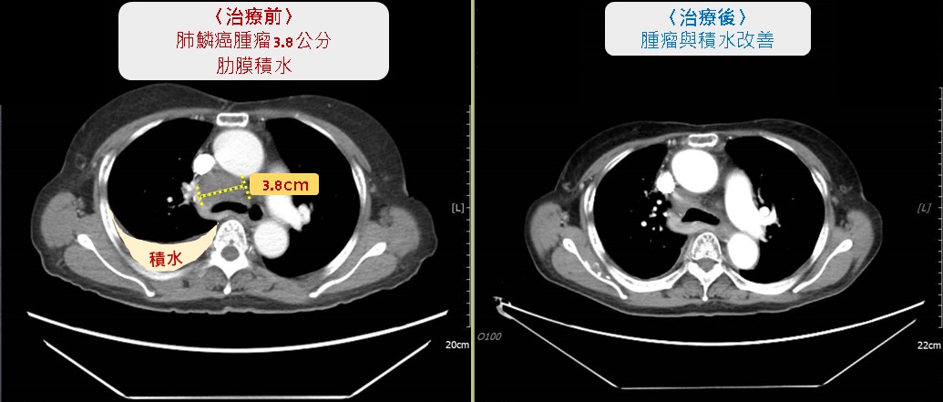 老菸槍小心肺鱗癌 中醫大新竹附醫籲定期檢查 治療前後