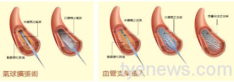 嚴重周邊動脈阻塞性疾病 控制阻塞危險因子避免截肢 洪國峻醫師新聞稿