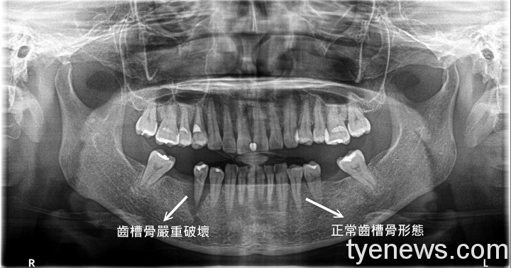 北榮桃分院:吸菸也會引起牙周病 養成好習慣口腔更健康 照片2 4