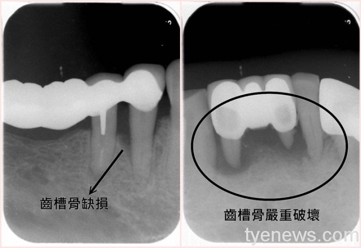 北榮桃分院:吸菸也會引起牙周病 養成好習慣口腔更健康 照片4