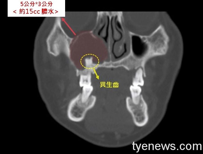 異生齒示意圖 異生齒示意圖