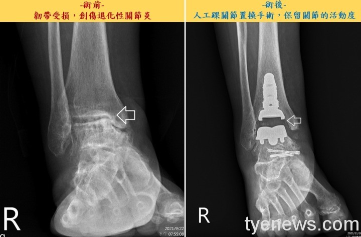 女病患10年腳踝扭傷致跛腳 人工踝關節置換手術5天改善 術前術後