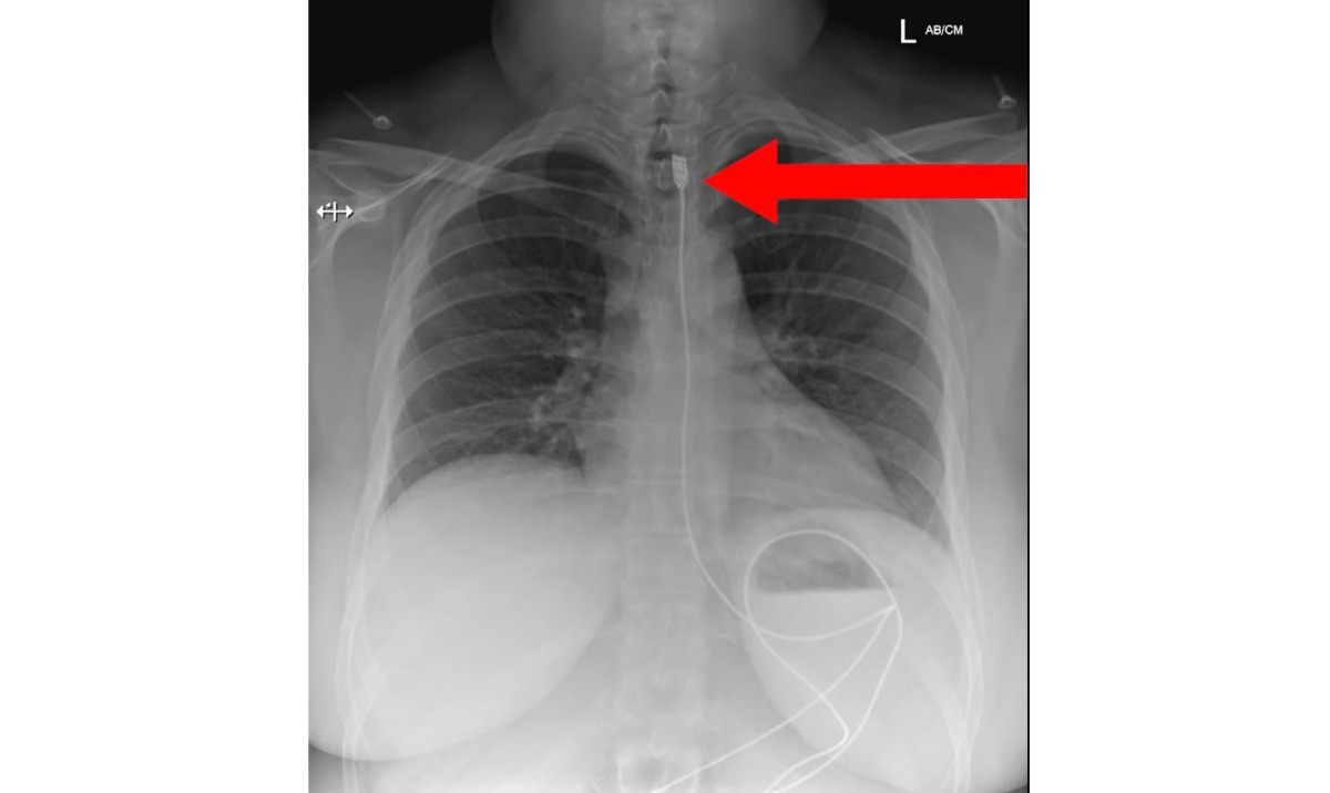 女險窒息送醫搶救 體內取出iPhone充電線
