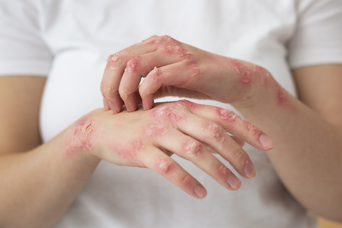 異位性皮膚炎反覆發作 3妙招減緩症狀 hands patient suffering from psoriasis