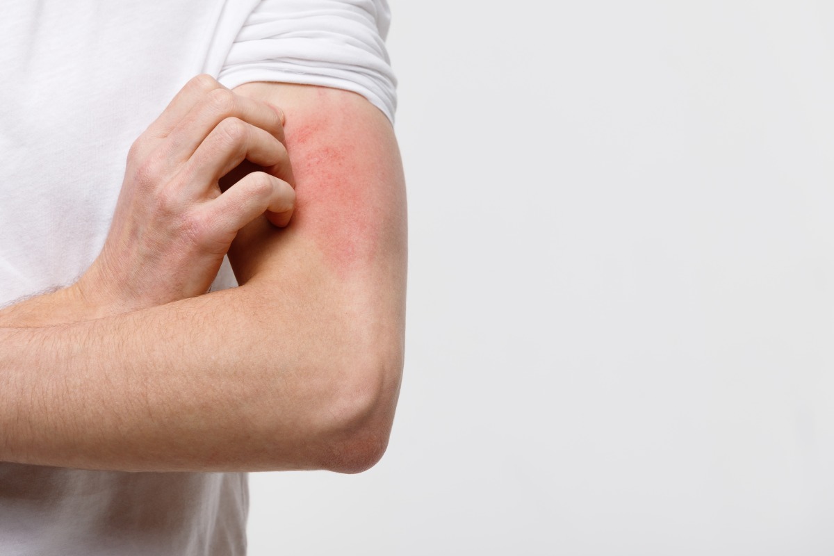 清明掃墓做好防護 恙蟲叮咬莫輕忽 close up male scratching itch his hand isolated grey background