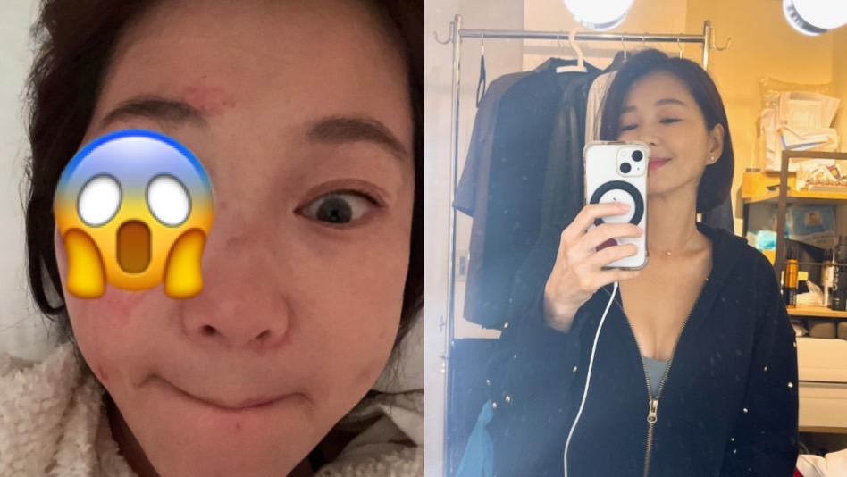 六月臉蛋血腫超誇張!親曝「人生疼痛最高峰」