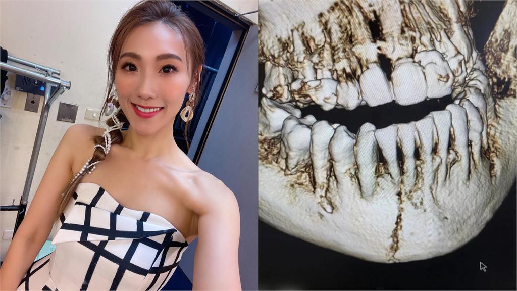 豬哥亮愛女謝金晶重摔「下顎骨斷兩半」!醫曝最慘後果