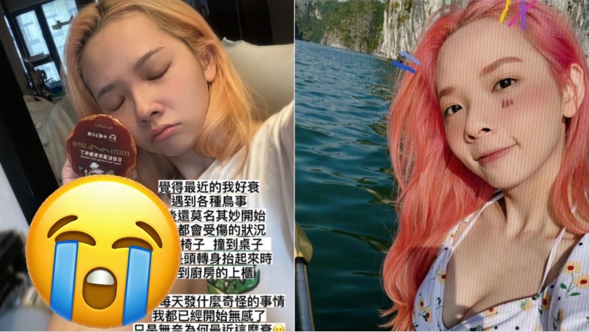 滴妹鳥事連連 雙腿大片瘀青照曝光:我好衰