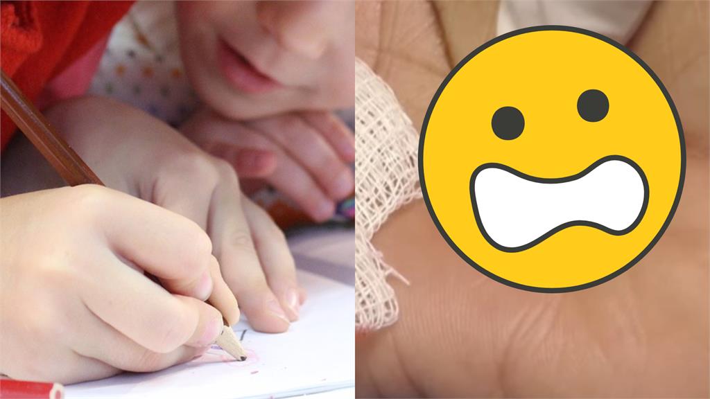 美國婦人「筆芯插手掌」45年沒拔!恐怖畫面流出