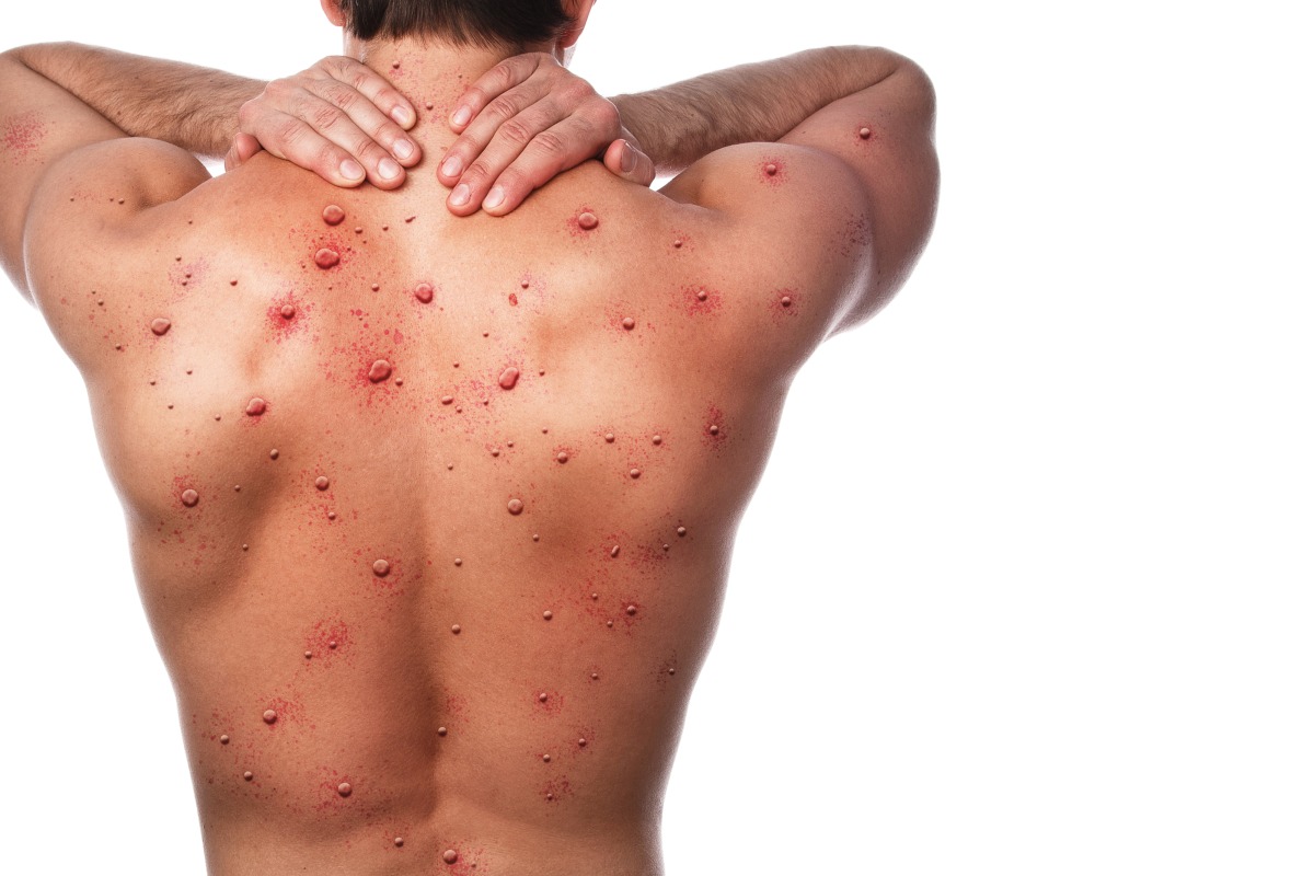 國內猴痘再增17例確診 疾管署籲「這類人」快打疫苗 male back affected by blistering rash because monkeypox other viral infection
