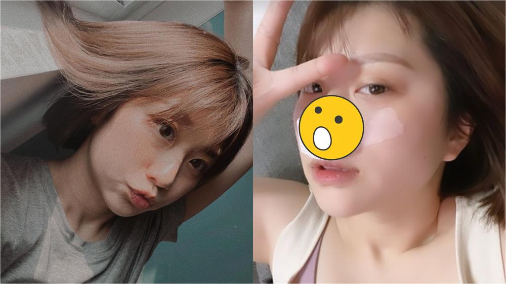 焦凡凡鼻子動刀「術後美照曝」 她親揭恢復狀況