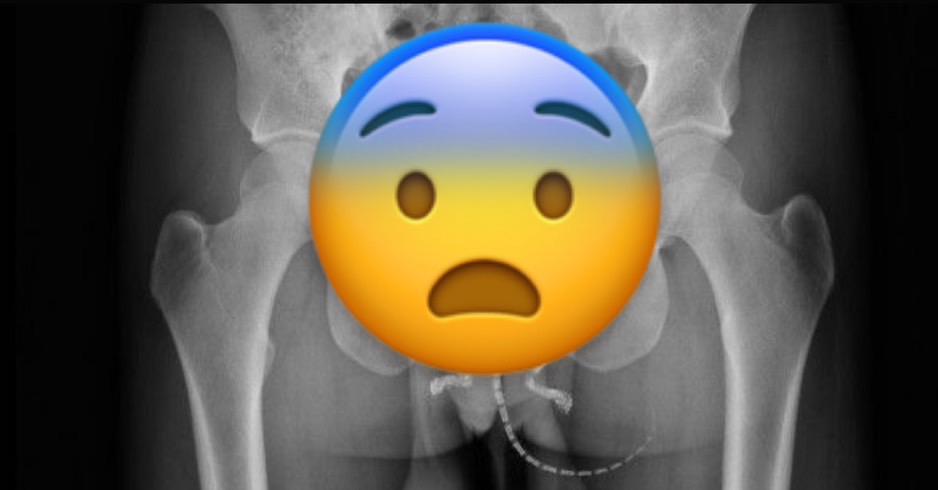 美男活松鼠「卡進這裡」!原因曝光X光片超驚人