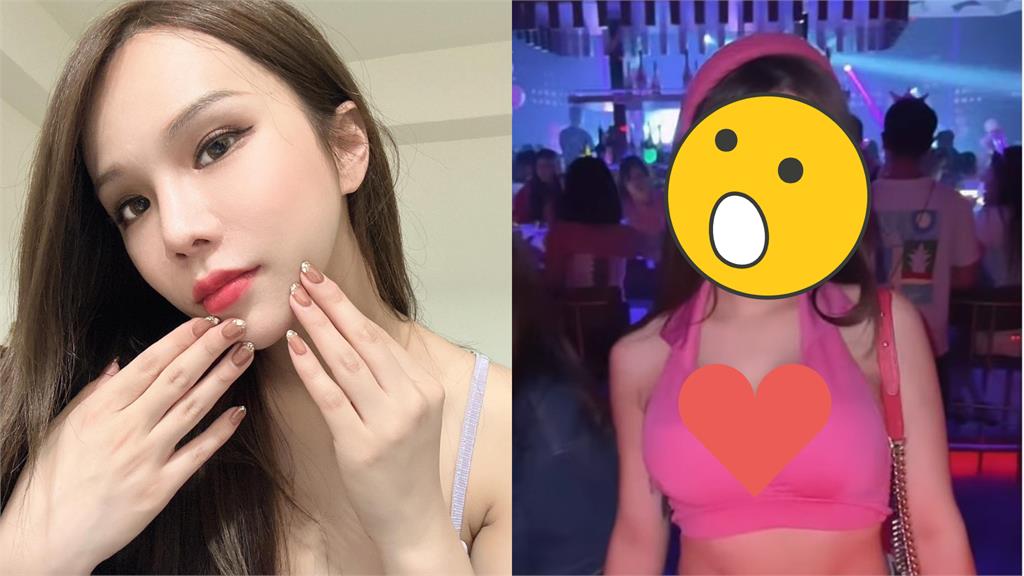 小A辣拿肋骨隆鼻!「術後10天」真實模樣曝光