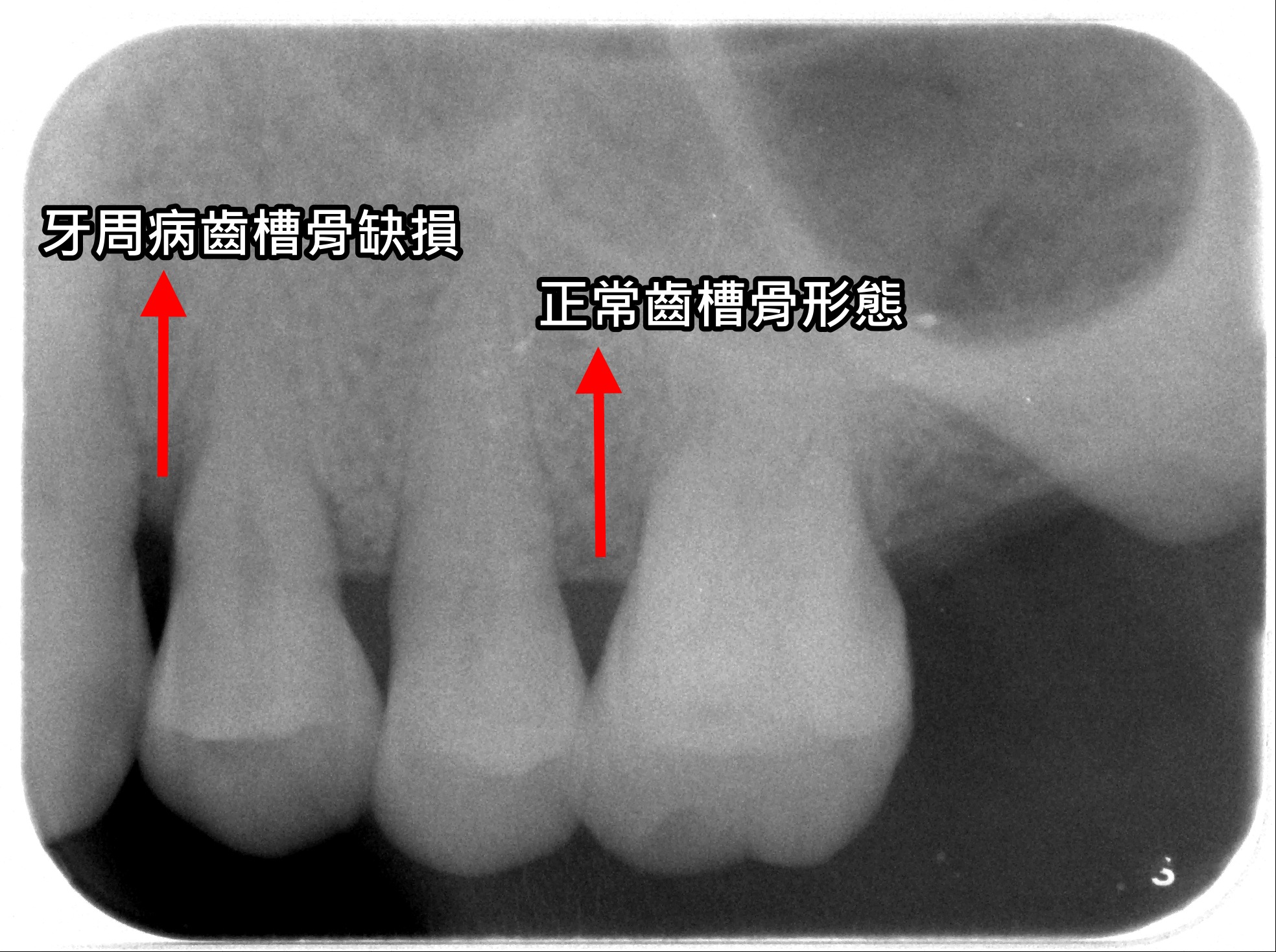 為美觀急做假牙 北榮桃分院:先解決這件事 1121108 2 0