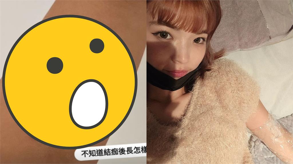 阿圓3度除刺青!曝「1部位」超有感:像被火柴燙