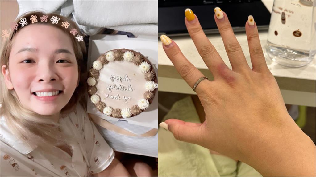 滴妹生日在醫院過!親曬瘀青照曝:莫名奇妙暈爆