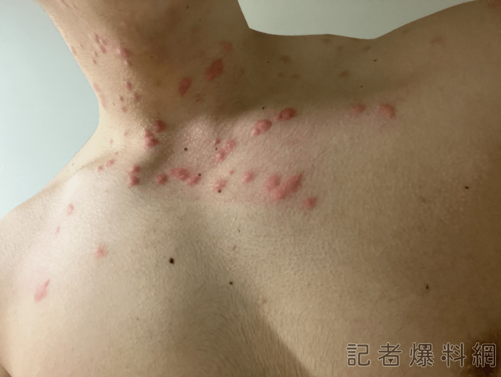 影/房間遭臭蟲入侵!全身被咬滿身紅包 苦主:被超級癢