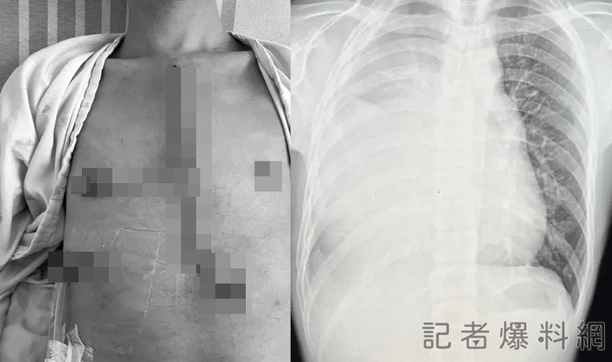 21歲陽光男不菸「肺部白了一片」 手術切除5公斤腫瘤！出院分享158天抗癌之旅