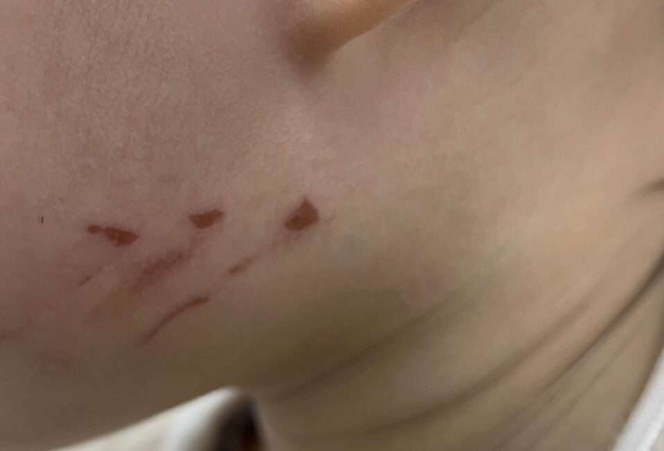 【有片】孫疑遭幼兒園教師指甲抓傷臉 阿公向黃瓊慧陳情淚崩