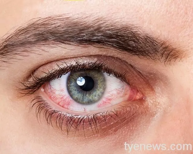 成年後近視度數居然逆襲?眼睛健康何去何從 成年後近視度數居然逆襲?眼睛健康何去何從