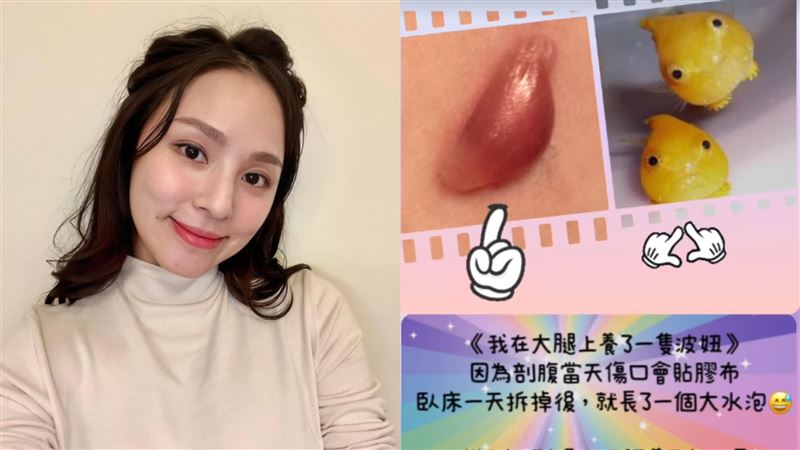 熊熊大腿長巨型水泡 產後近況曝光