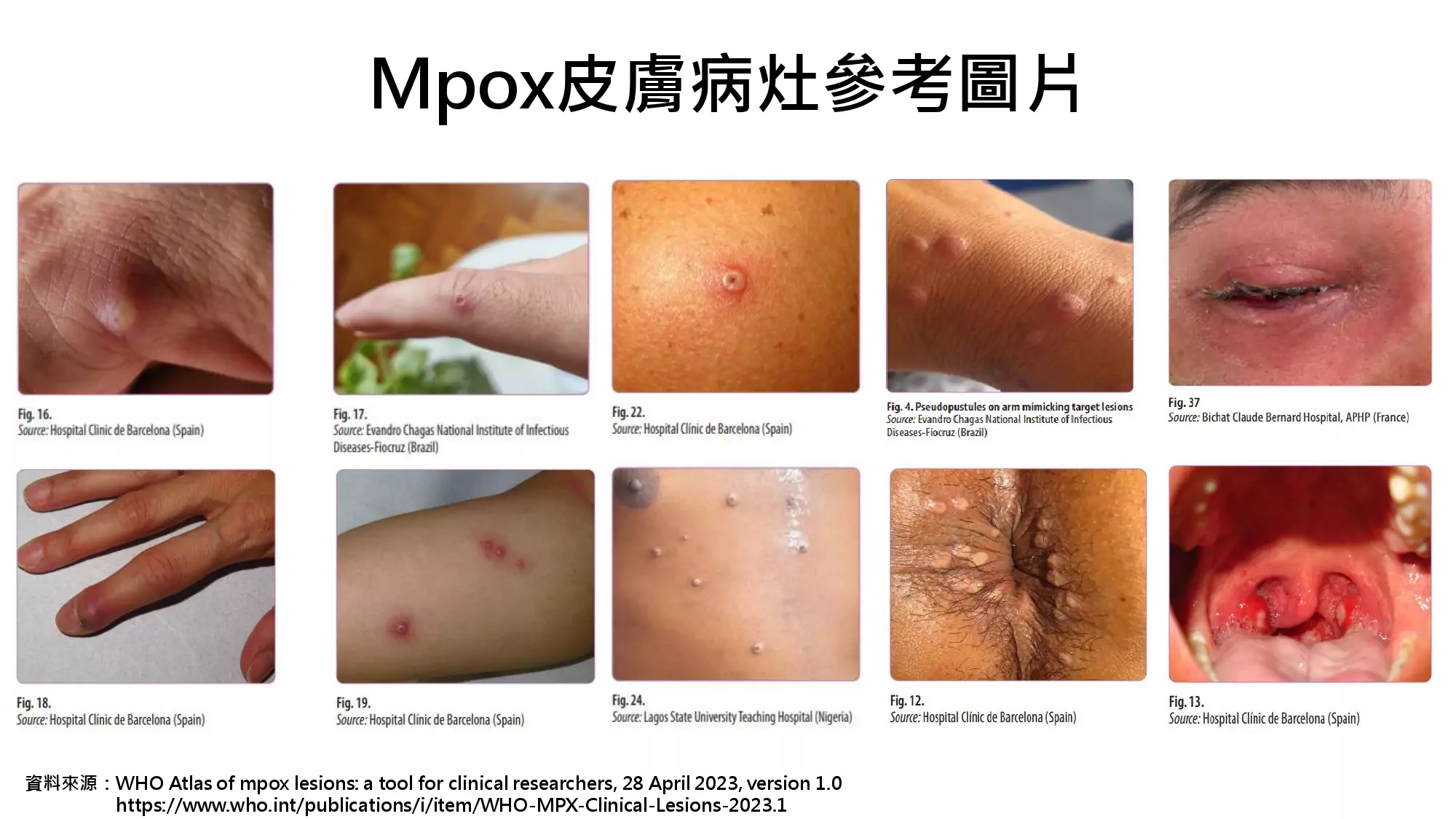 M痘病灶 page 0001