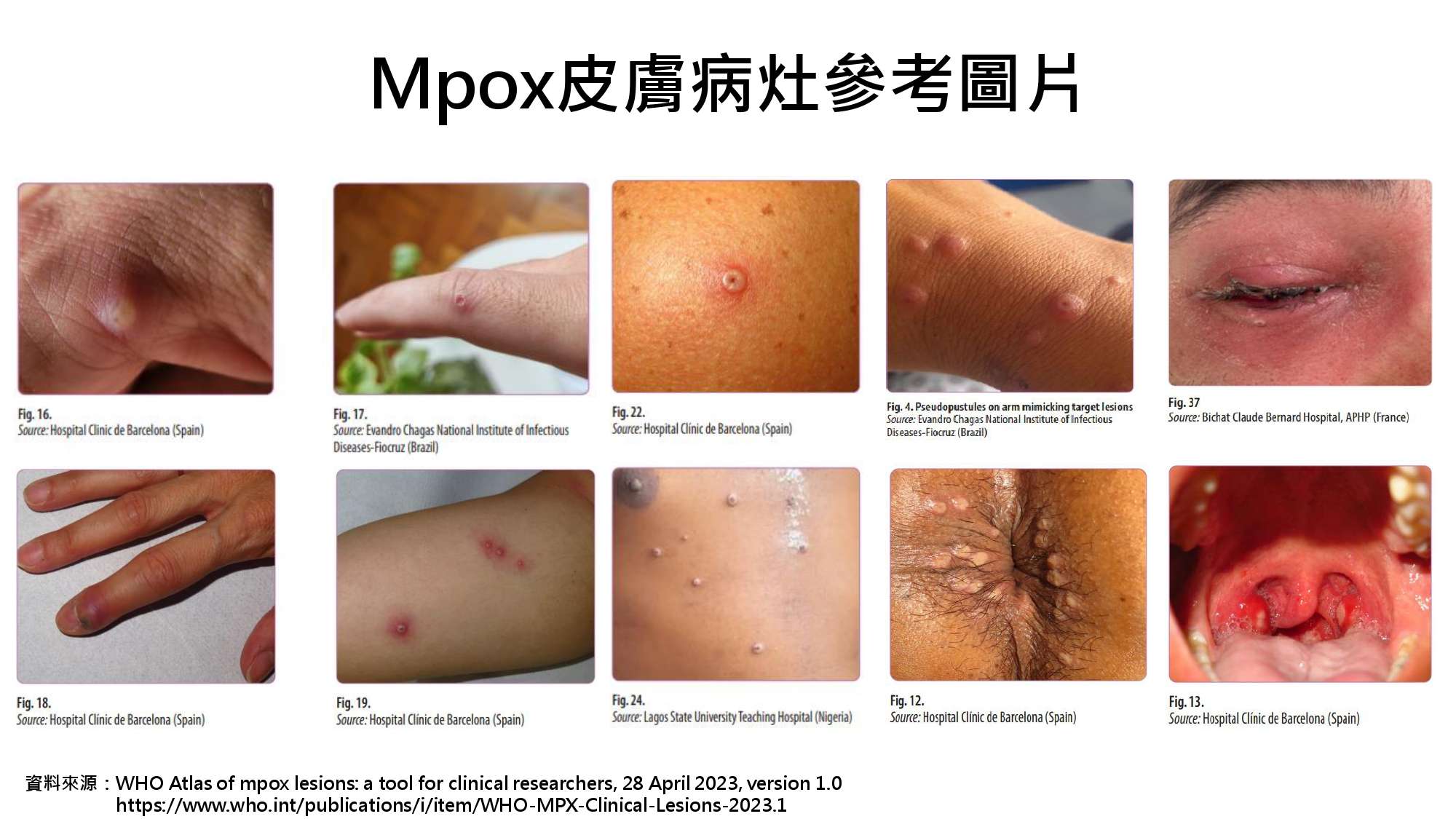 猴痘正名「M痘」 北榮桃園分院曝預防方式