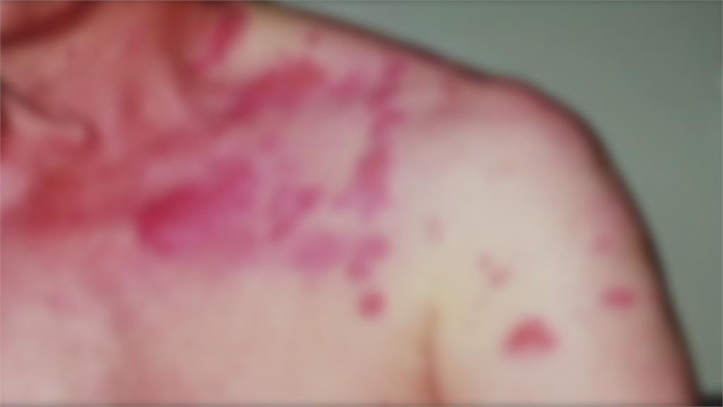 逾50歲易得帶狀疱疹 80歲以上3人就有1人