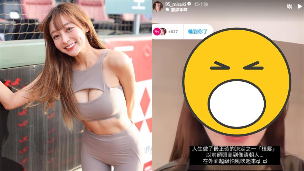 林襄「死亡視角」掀開瀏海!髮際後退「崩壞變清朝人」認:植髮了