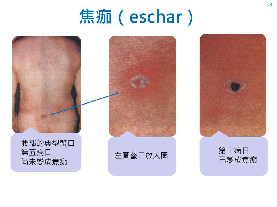 清明掃墓小心恙蟲叮咬!桃園衛生局提醒這些事 46846556