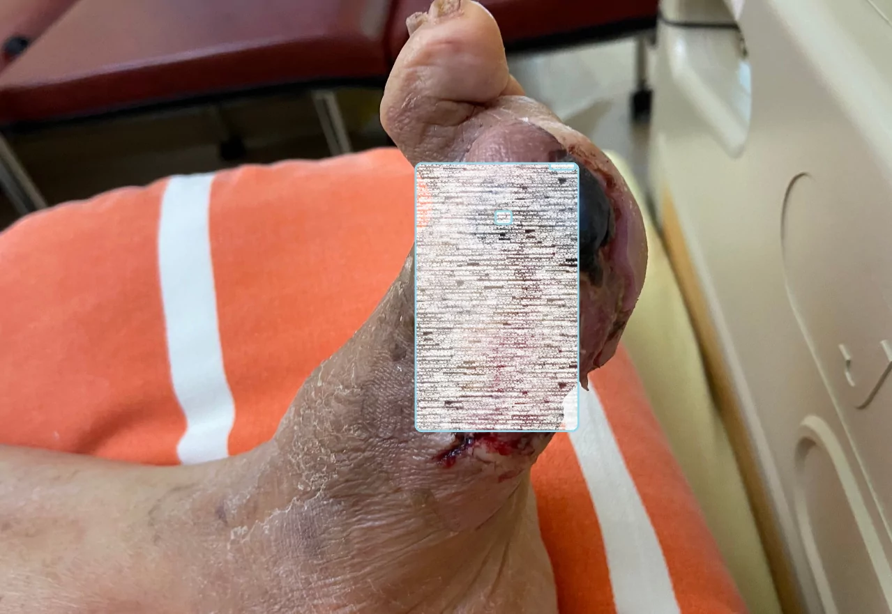 糖尿病患足部傷口不可輕忽 部桃:嚴重恐截肢 糖尿病患足部傷口不可輕忽 部桃:嚴重恐截肢