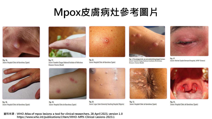 疾管署提升旅遊警示 籲民眾關注M痘疫情並加強防護措施 123 1
