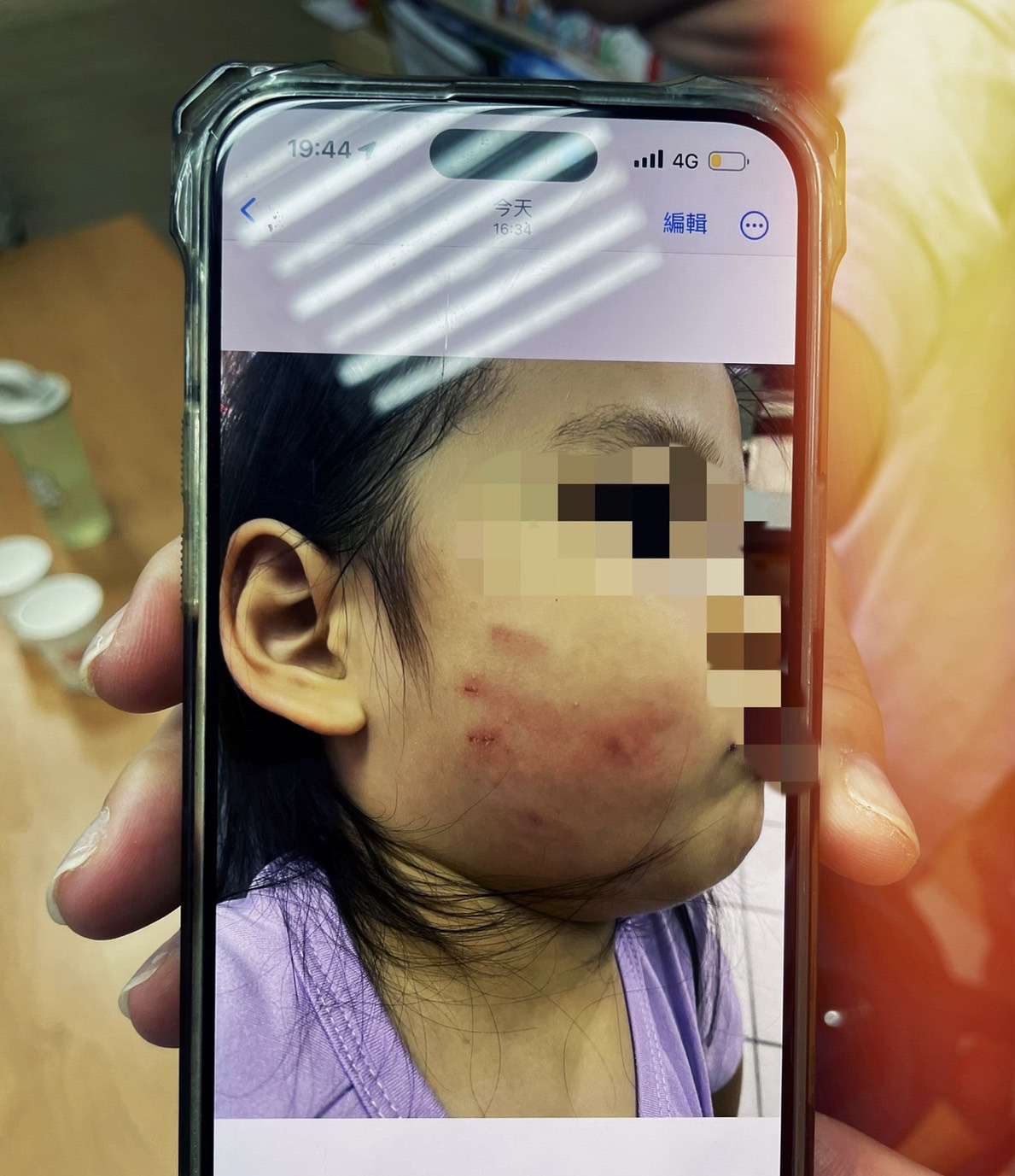 女童遭掌摑臉部紅腫「留指印」 黃瓊慧:涉施暴教保員還沒停職 S 361119844 0