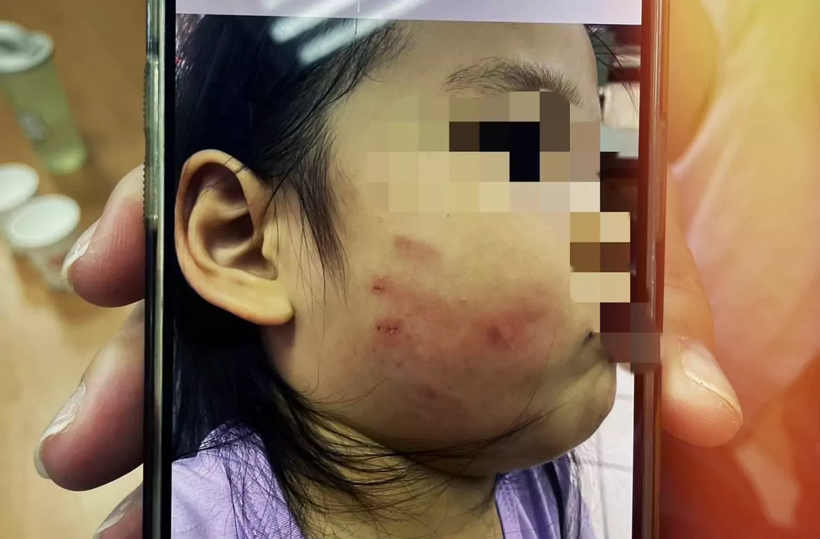 女童遭掌摑臉部紅腫「留指印」 黃瓊慧:涉施暴教保員還沒停職 女童遭掌摑臉部紅腫「留指印」 黃瓊慧:涉施暴教保員還沒停職