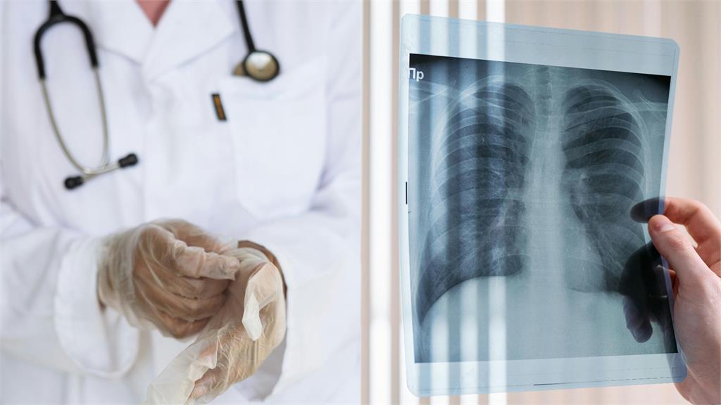 汪建民肺腺癌離世 6高危險族群8大症狀要注意