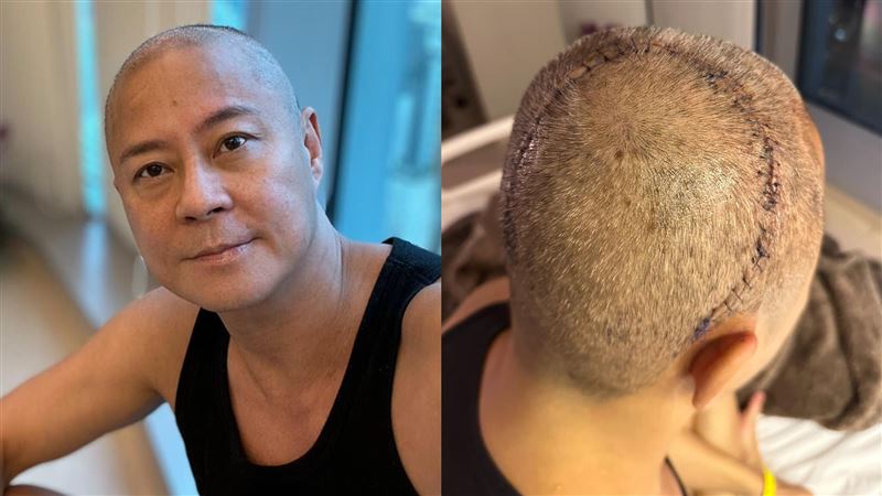 草蜢蔡一傑確診腦瘤 他透露手術後心路歷程
